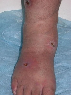 Нога после лечения пиявками