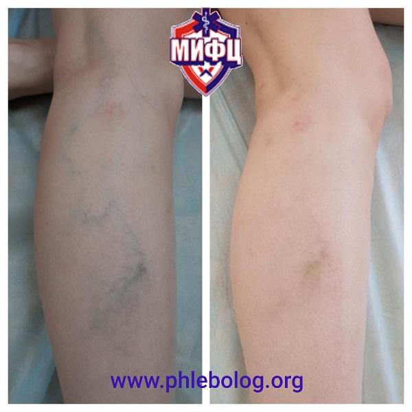 Фото до и после склеротерапии (склерозирования) варикозно расширенных вен на ногах
