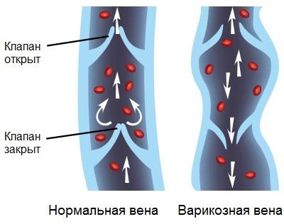 венозные клапаны на ногах