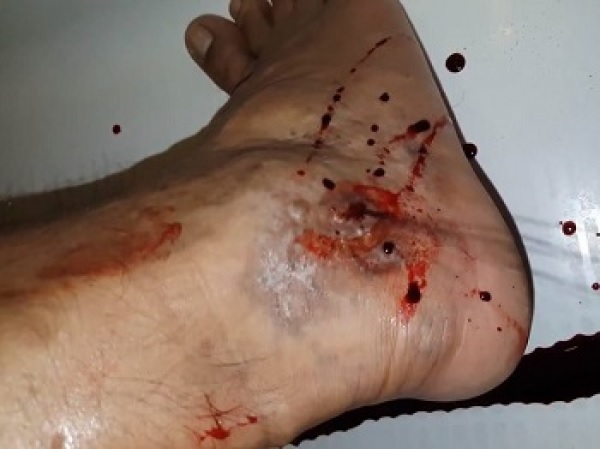 Bleeding from varicose veins in the leg