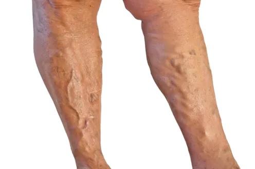 tratamentul picioarelor varicoase varicoase prin metoda poporului geluri pentru tratamentul venelor vene