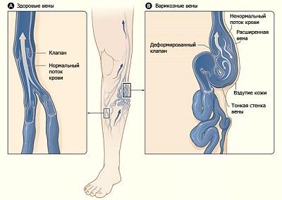 сколько вен можно удалить на одной ноге при варикозе
