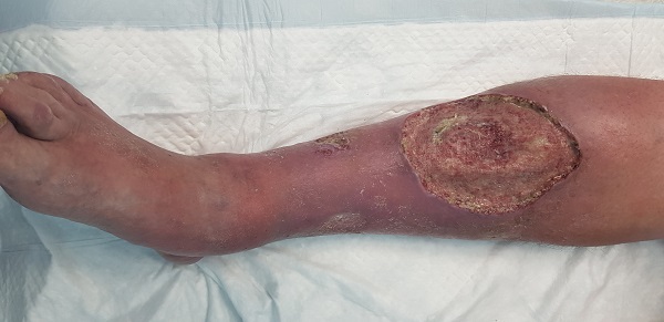 Large trophic ulcer on the lower leg
