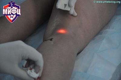 Лечение варикоза лазером в Москве в клинике «МИФЦ»