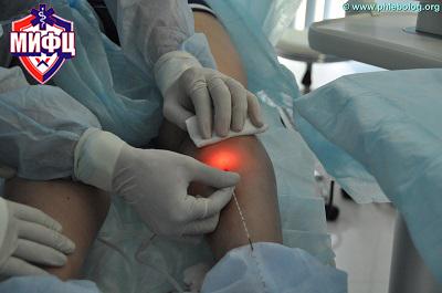 Проведение инновационной лазерной процедуры в нашем флебологическом центре в Москве