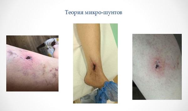 Осложнение склеротерапии - некроз кожи (эпидермолиз)