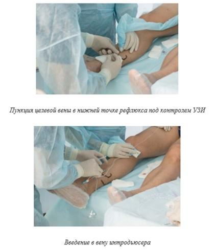 Применение лазерной хирургии в комплексном лечении пациентов с тромбофлебитами и тромбозом венозного русла