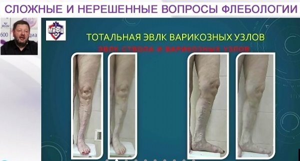 «Тотальная ЭВЛК варикозных узлов» - докладывает Федоров Д.А.