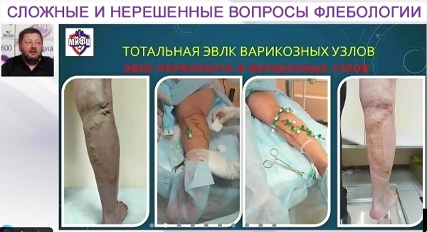 Результаты лечения варикоза методом Total ЭВЛК в исполнении Федорова Д.А.