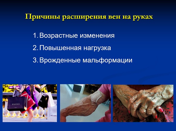 Причины расширения вен на руках