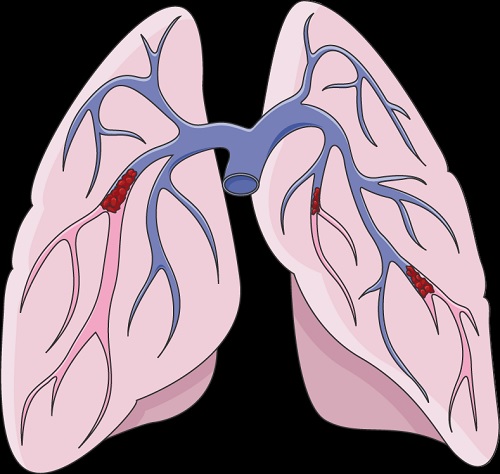 Pulmonary artery thromboembolism TELA