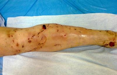 Так выглядит нога после классической флебэктомии