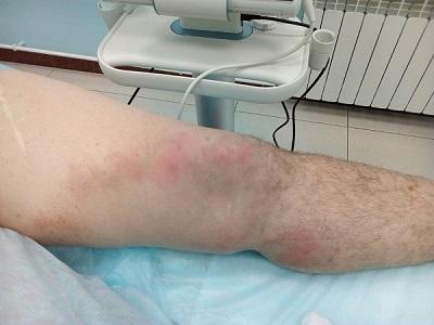 Treatment of thrombophlebitis by EVLK method in our Research Institute of Phlebology