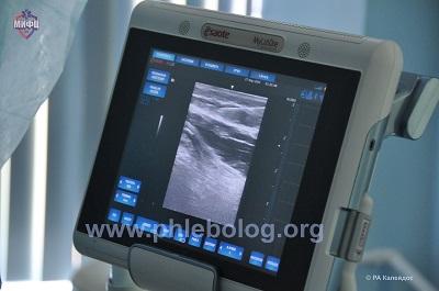 Ультразвуковой сканер для исследования венозной системы нижних конечностей
