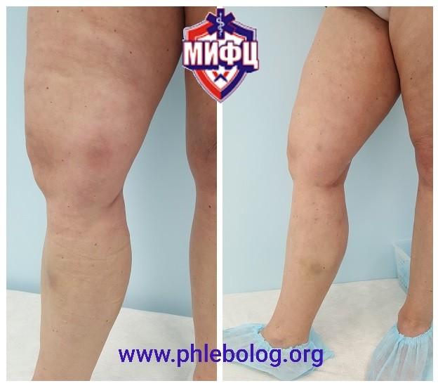 a varikózis oka a lábakon fotó a láb duzzanata visszeres terhes nőknél