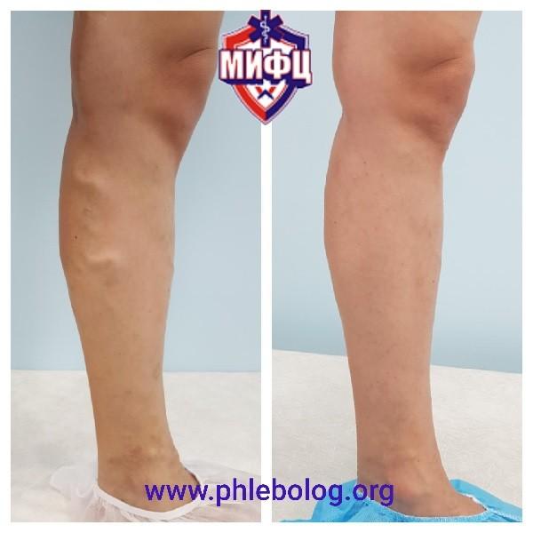 a varikózis oka a lábakon fotó torna thrombophlebitis és visszér ellen