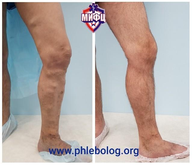 Varicose vénák a lábakon: tünetek és kezelés A lábak varikózisának utolsó szakasza fényképpel