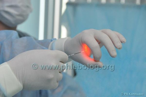 Лазерная облитерация вен в клинике флебологии "МИФЦ"