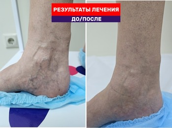 Результат удаления сосудистых звездочек Ноги без сеточек: это не магия, это склеротерапия