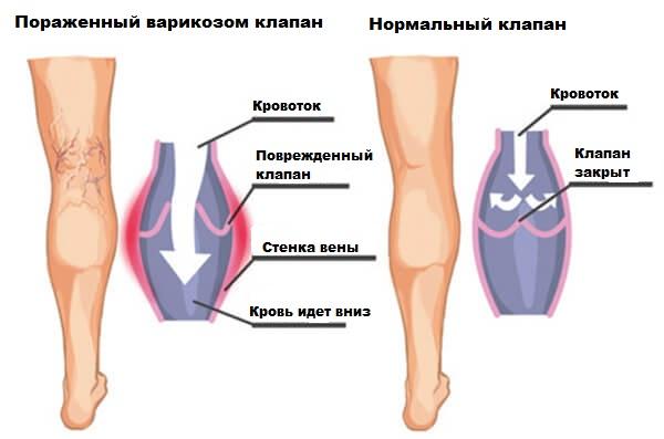 Фазный кровоток в венах нижних конечностей что это значит