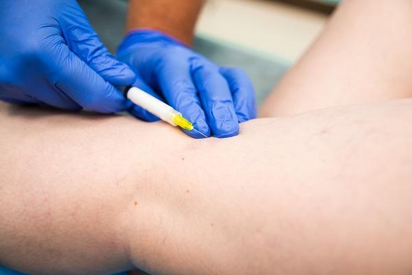 varicose vein sclerotherapy