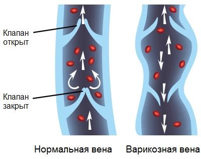 Варикозное расширение вен при венерических заболеваниях thumbnail