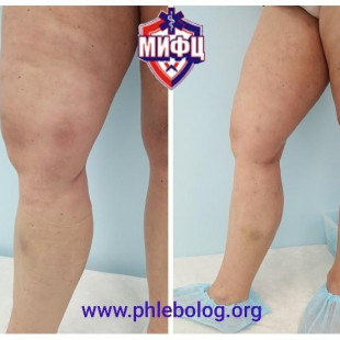 Лечение острого тромбофлебита методом ЭВЛК - лазерной коагуляцией