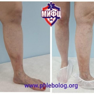 Лечение тромбофлебита в области трофических расстройств