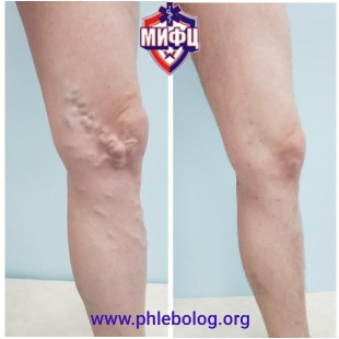 Лечение варикоза в области колена с помощью минифлебэктомии по Варади