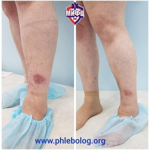 Лечение трофической экземы лазером