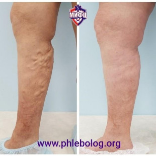 Лечение варикоза радиочастотой без следа