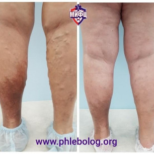 Лечение варикоза и венозной экземы методом РЧА