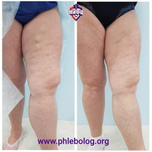 Результат удаления переднелатерального притока на бедре лазером