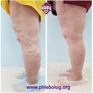 Лечение варикозного расширения вен  без операции