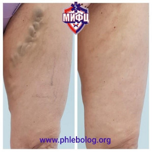 Удаление варикозных вен методом минифлебэктомии по Варади