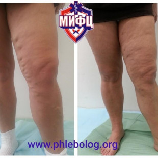 Лечение запущенного варикоза методом ЭВЛО - лазерной облитерацией