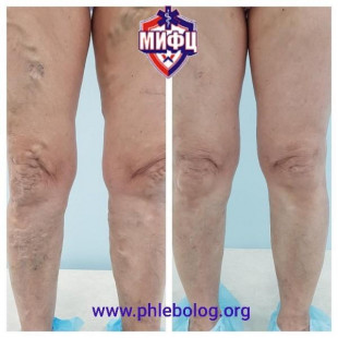 Лазерное лечение варикоза на обеих нижних конечностях