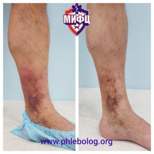 Лечение острого тромбоза на фоне трофической экземы