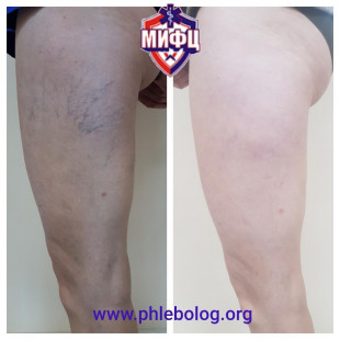 Удаление некрасивых звездочек трансдермальным лазером