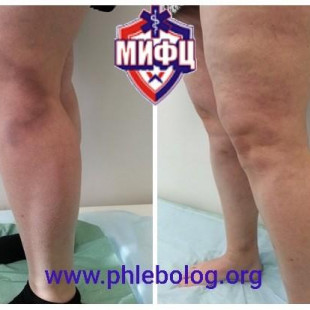 Лечение острого тромбоза притока БПВ новым лазером
