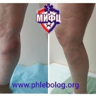 Лечение варикотромбофлебита в бассейне БПВ справа