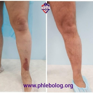 Трофическая экзема - лечение лазером без операции