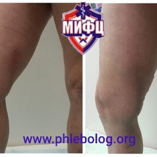 Острый восходящий тромбоз в бассейне БПВ справа