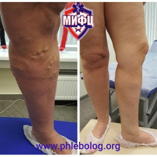 Лечение варикоза методом РЧА - радиочастотной абляцией