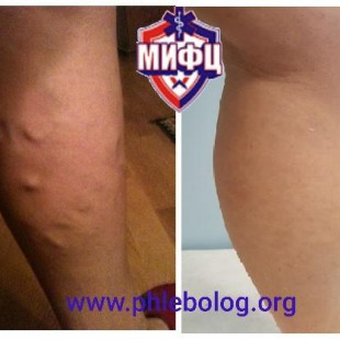 Радиочастотное лечение варикозной болезни - радиочастотная абляция