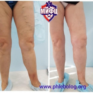 Лечение трофической экземы лазером и минифлебэктомией