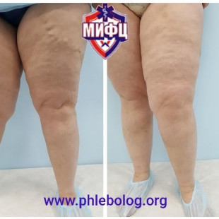 Лазерная коагуляция и минифлебэктомия по Варади