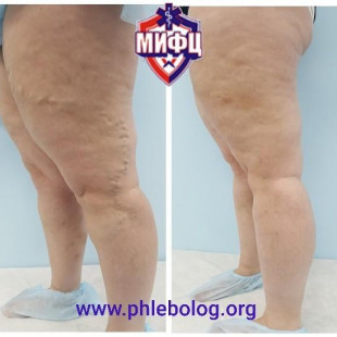 Минифлебэктомия по Варади на левой нижней конечности