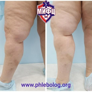 Острый тромбофлебит в бассейне БПВ справа - лечение лазером
