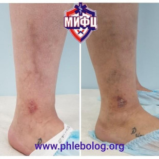 Лечение трофической венозной экземы лазером
